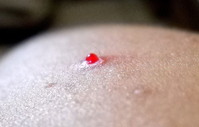 Four Common Skin Diseases